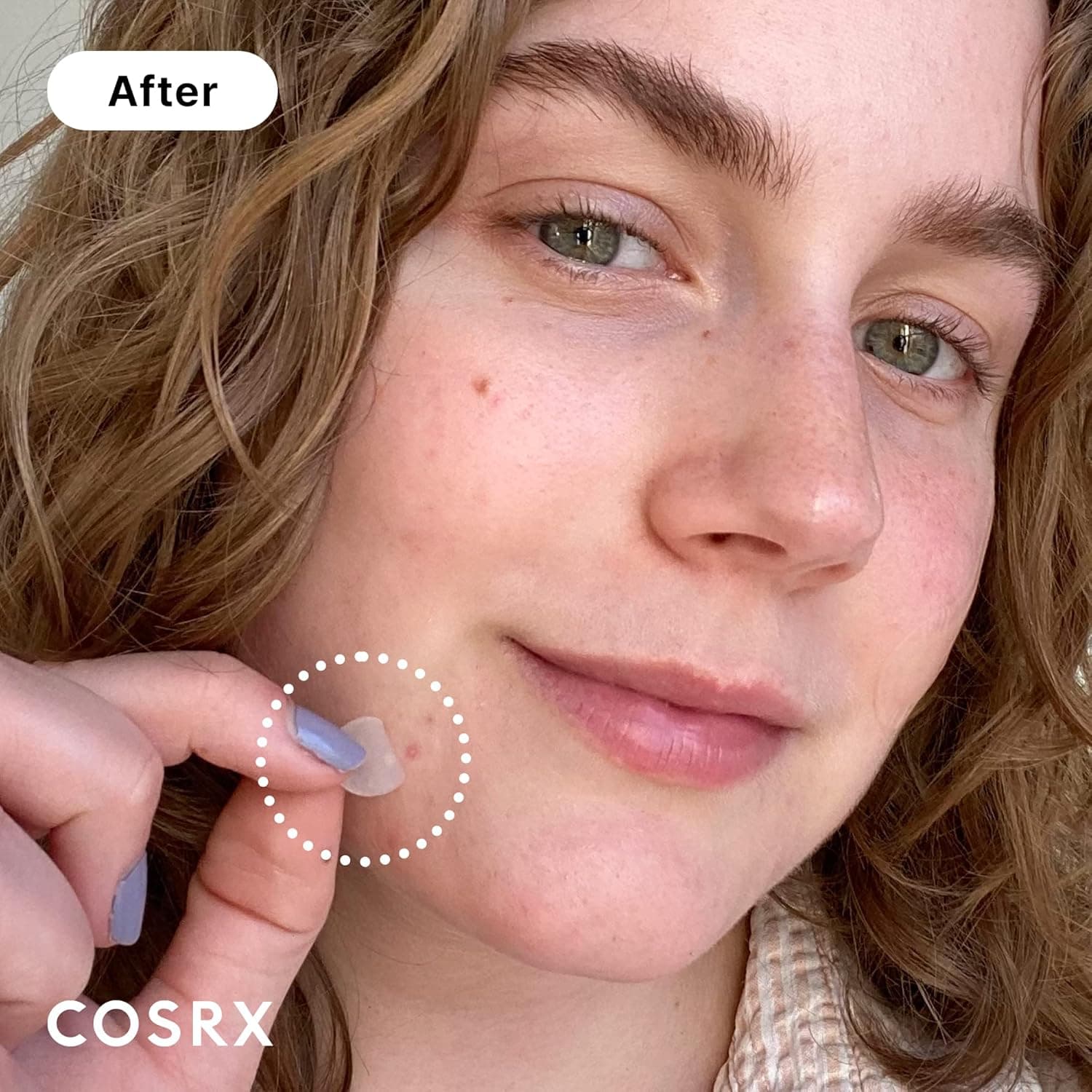Acne Pimple Master Patch 2